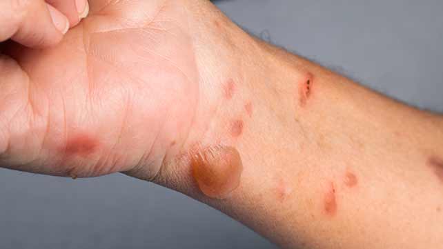 blister from burn