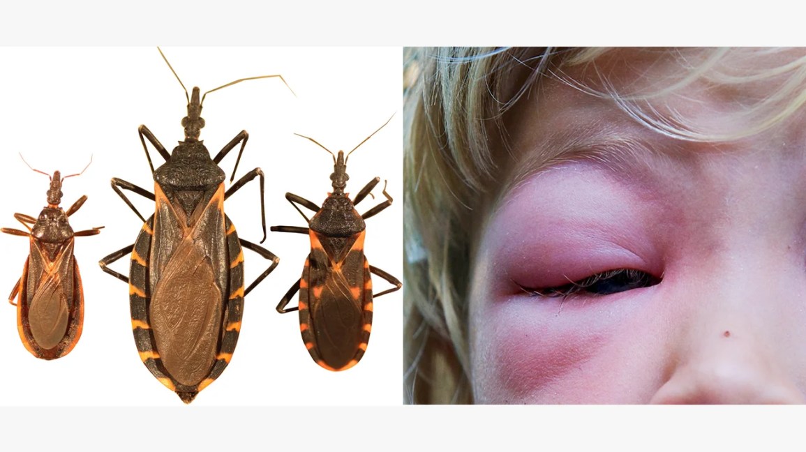 kissing bug bite