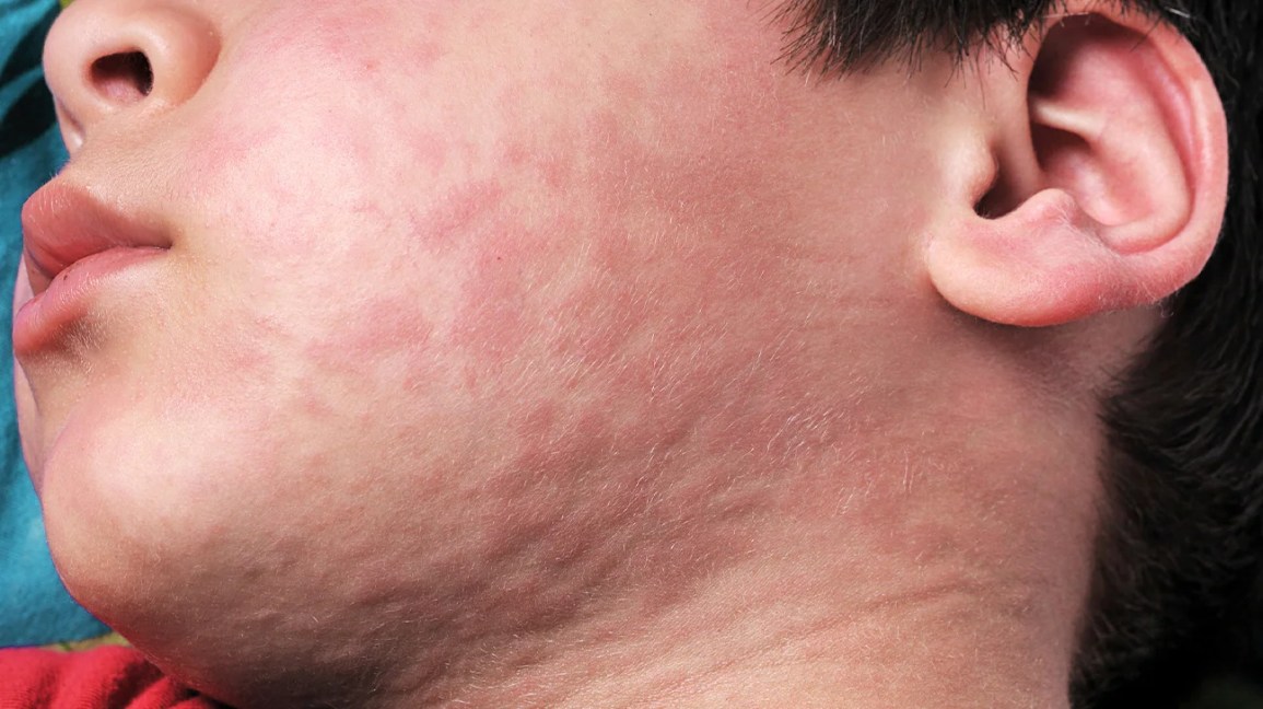 Hives on a child's face